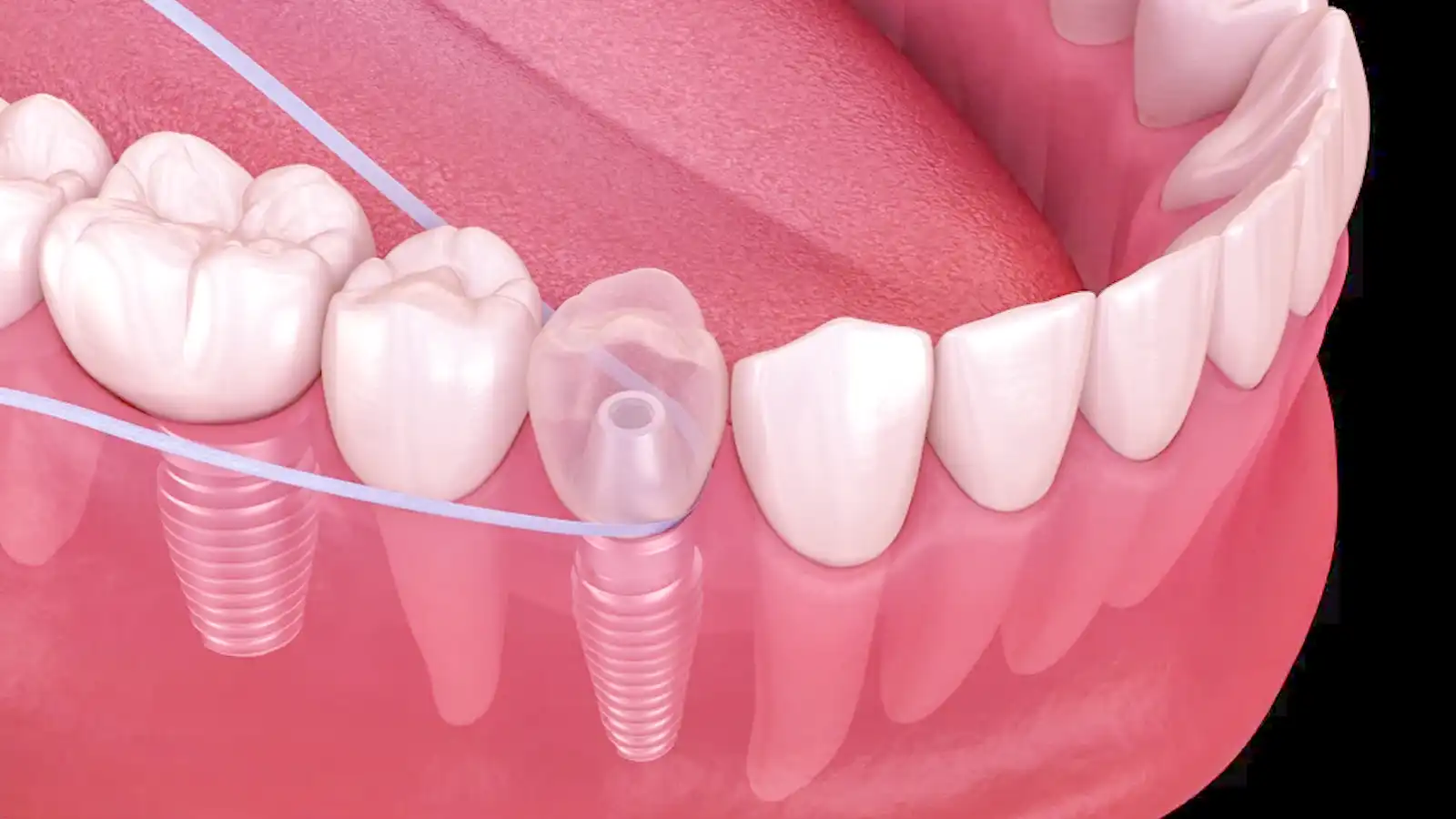 How Long Do Dental Implants Last and How to Care for Them?