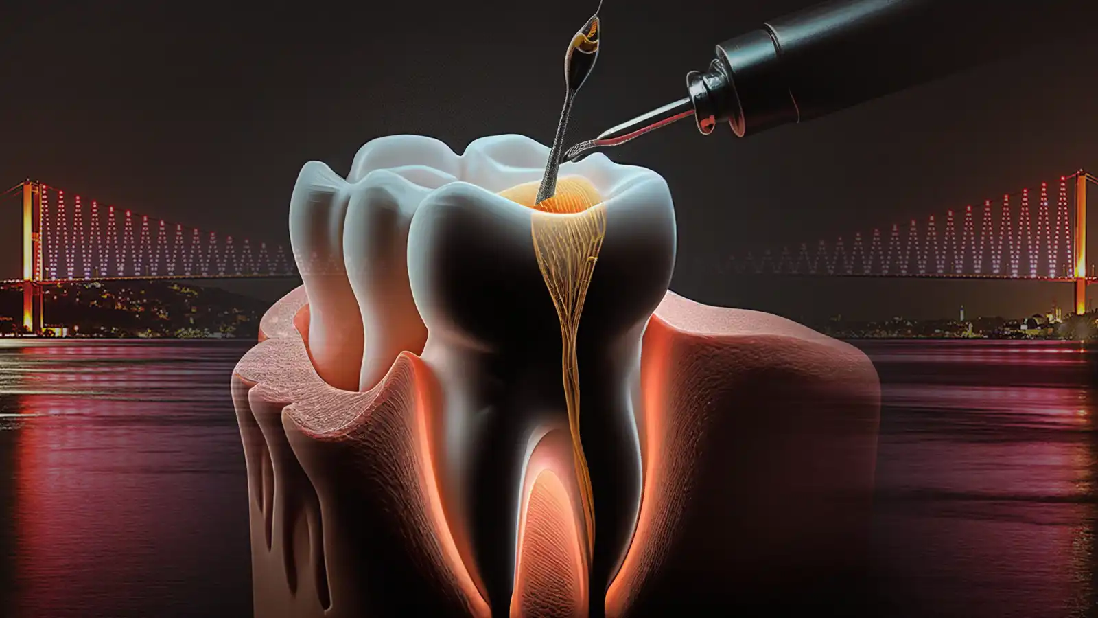 Root Canal Treatment in Istanbul: What to Expect?