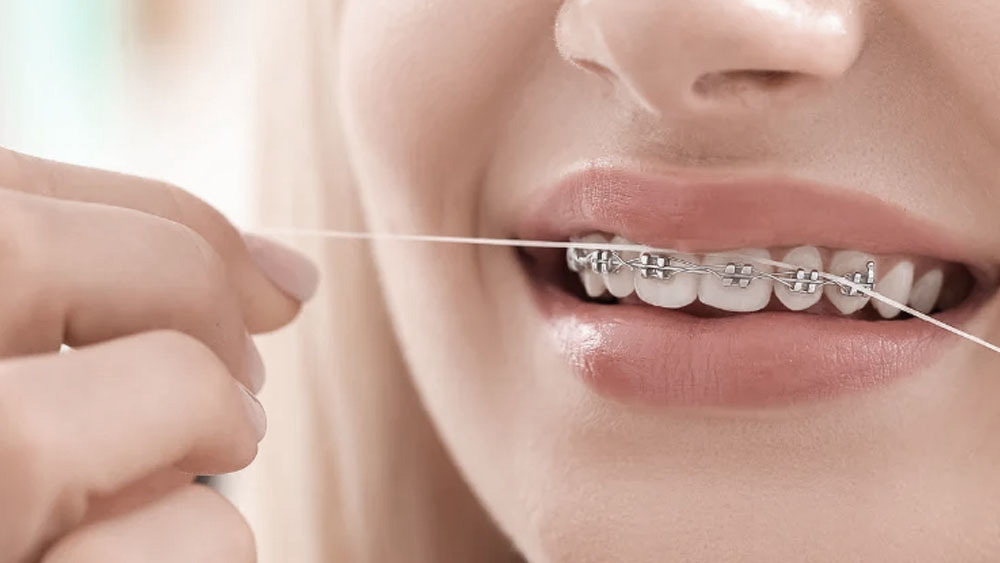 Maintaining Oral Hygiene with Braces