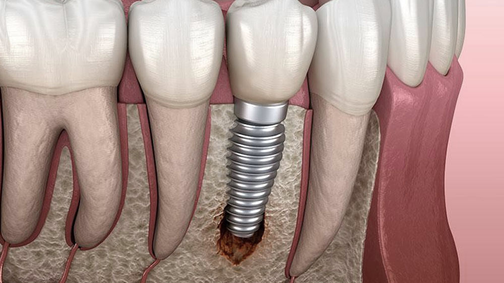 Can Dental Implants Fail? Understanding the Risks and Prevention