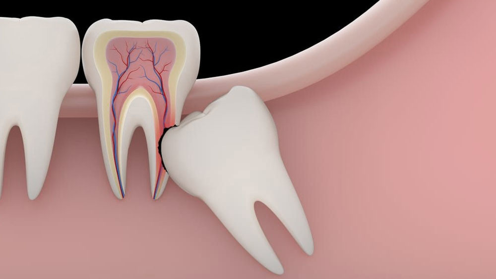 Wisdom Tooth Removal: When is it Necessary?