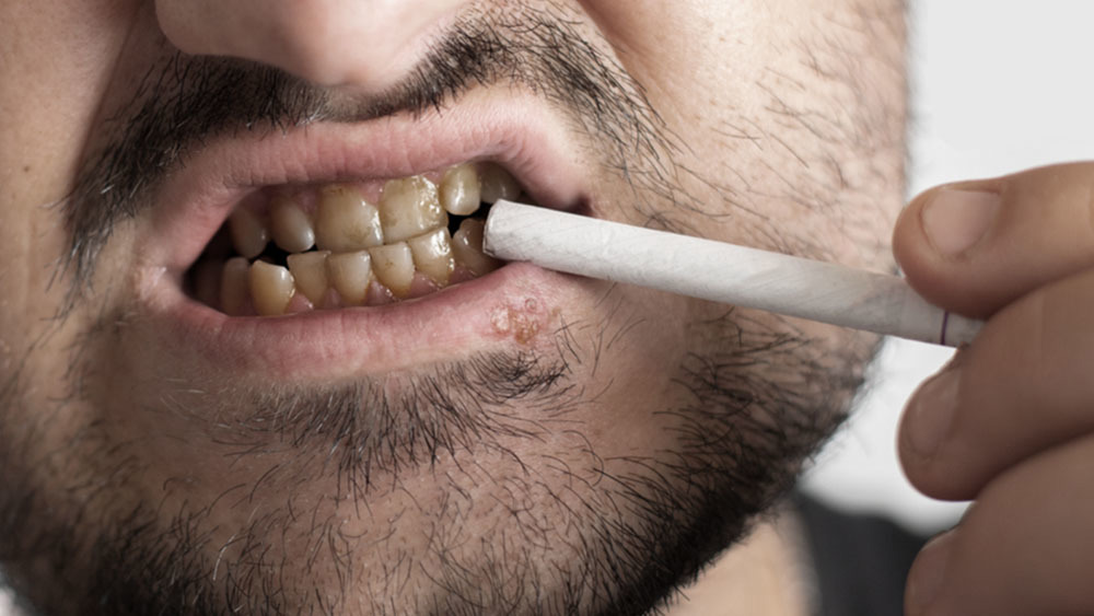 The Impact of Smoking on Your Oral Health